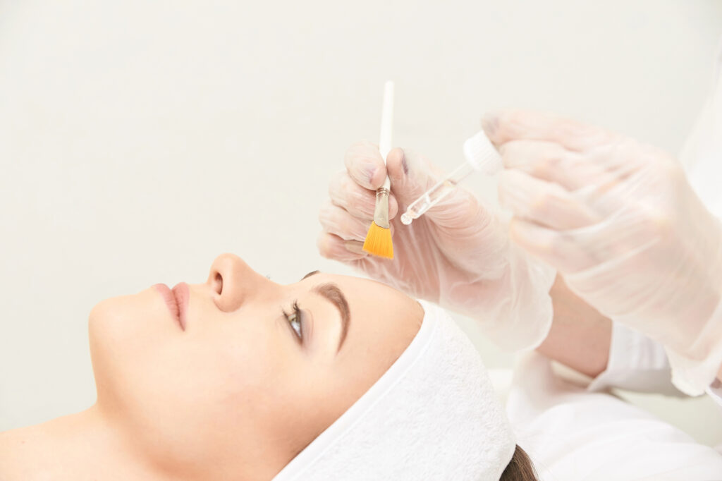 Chemical Peel for Acne Scars