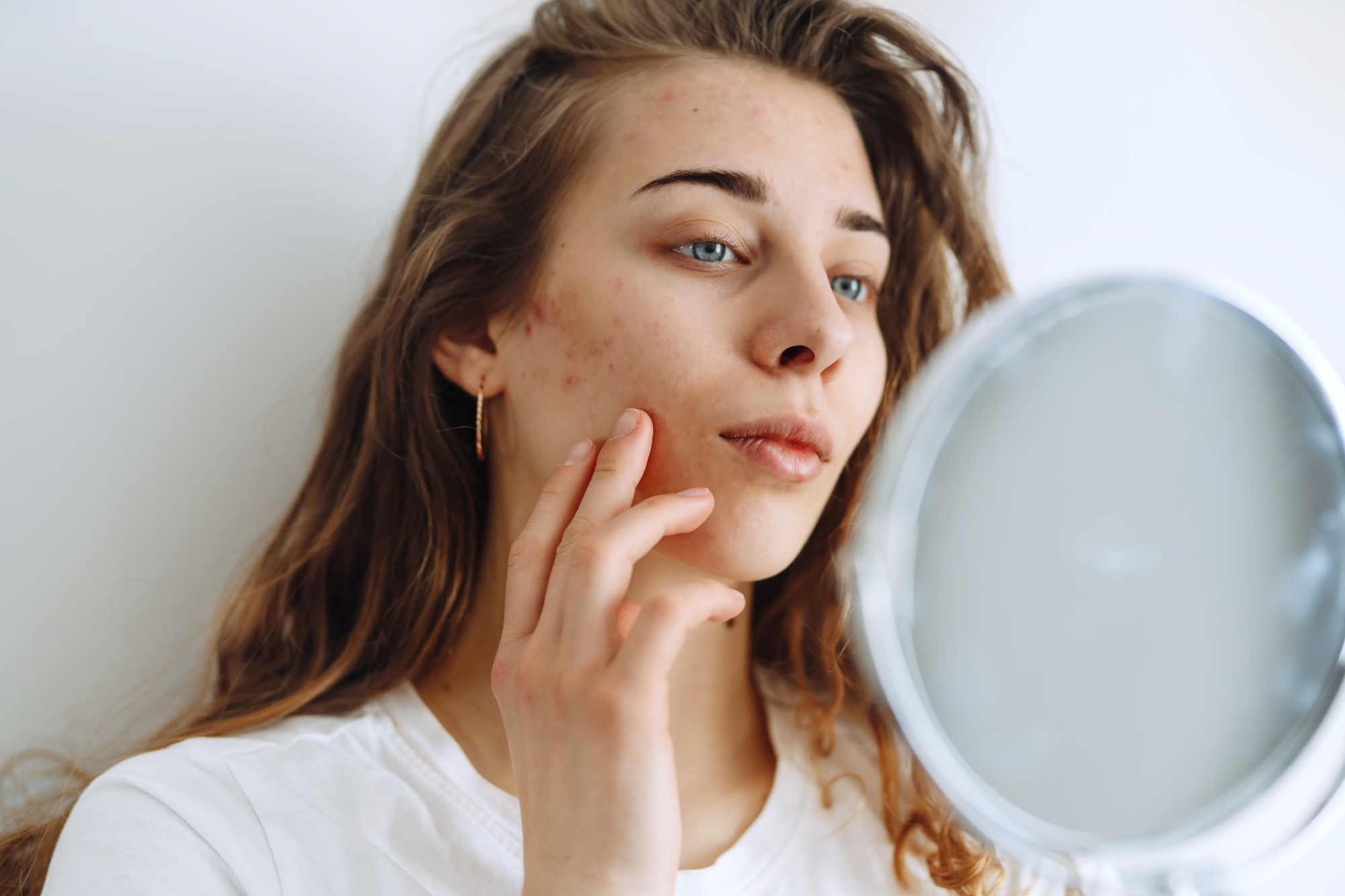 Chemical Peel for Acne Scars